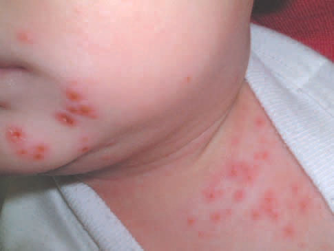 Hazelnut Rash Get Well With singel Remedy: SCABIES (ERUPTIONS) eczema 2