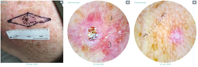 Squamous Cell Carcinoma Full body skin check Gold Coast