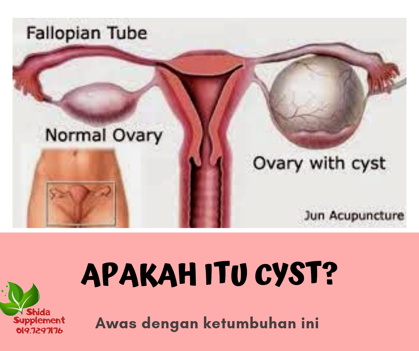 Tanda Tanda Cyst Ovari 5 Tanda Ini Bermakna Anda Ada Masalah Serius Theasianparent Malaysia