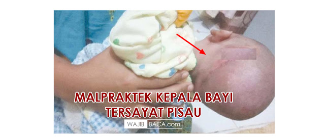 Diduga Salah Penanganan Medis Kepala Bayi ini Tersayat Pisau Saat Lahiran