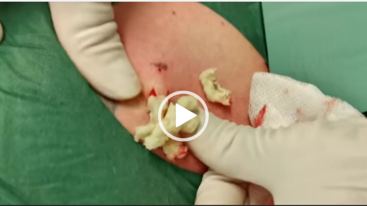 Massive Pimple Explosion. Cyst Removal Clinic London