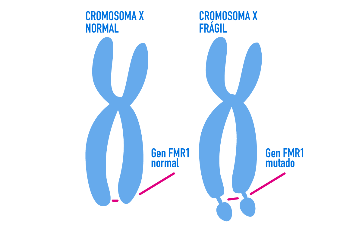 Síndrome del Cromosoma X fràgil Localització en el cromosma