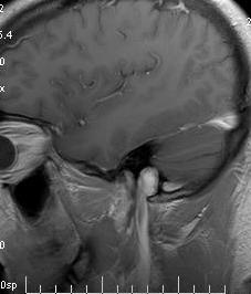 venous sclerosis insufficiency