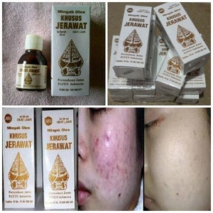 Obat Jerawat Cap Wayang asli/murah/original/supplier kosmetik