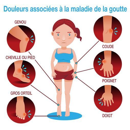 Traitement des crises de goutte Nos Conseils de Vie