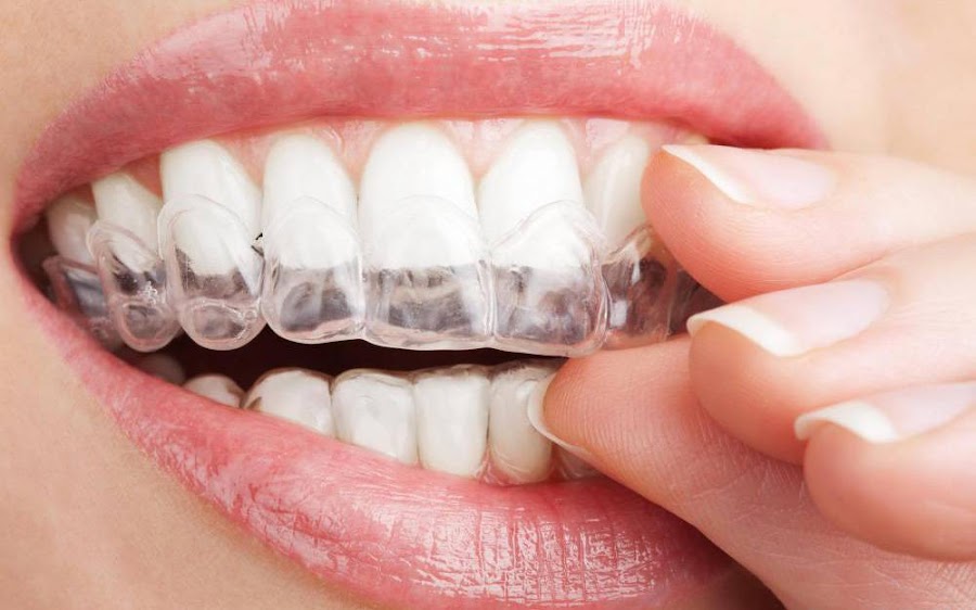 ferulas blanqueadoras