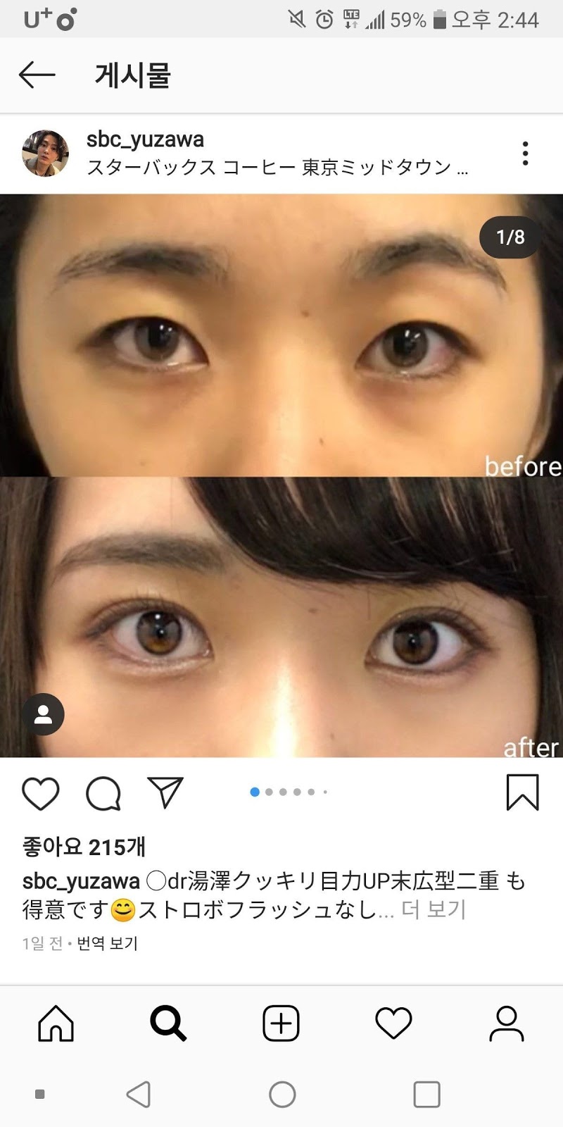 [theqoo] JAPANESE DOUBLE EYELID SURGERY THAT'S VERY NATURAL PANN좋아!