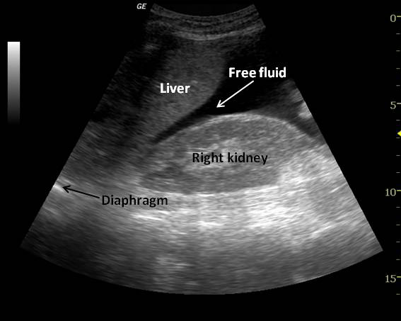 MEDICAL ULTRASOUND/FAST SCAN IN EMERGENCY