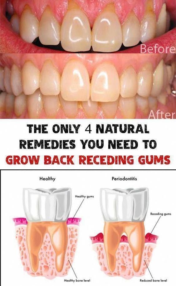 The Only 4 Natural Remedies You Need To Grow Back Receding Gums and