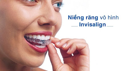 Niềng răng Invisalign là gì?