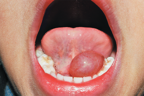 Oral mucocele: A clinical and histopathological study