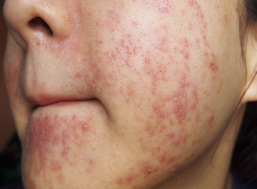Sử dụng Kem bôi da Trangala để trị mụn bọc, mụn trứng cá là sai lầm tai hại