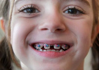 Nguyên nhân trẻ chậm thay răng sữa -1