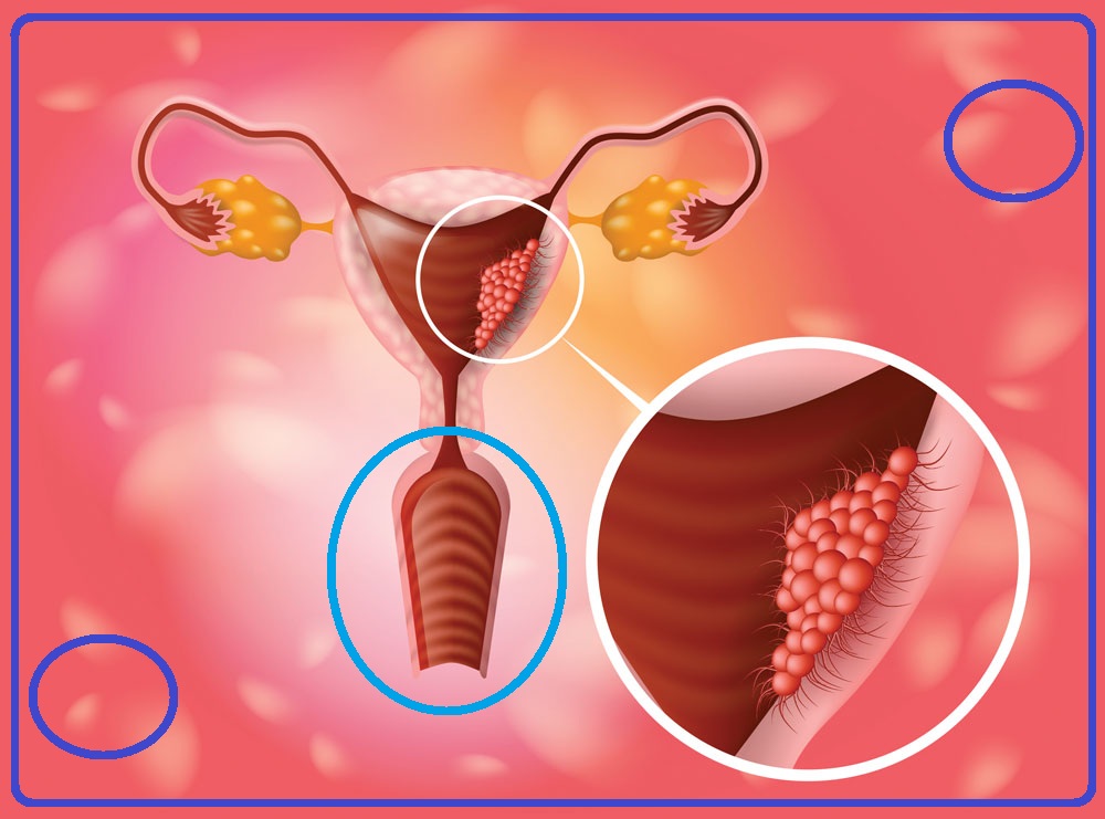 علاج التهابات المهبل كل ما تحتاجي لمعرفته حول التهاب المهبل وعلاجه طبيب فور يو