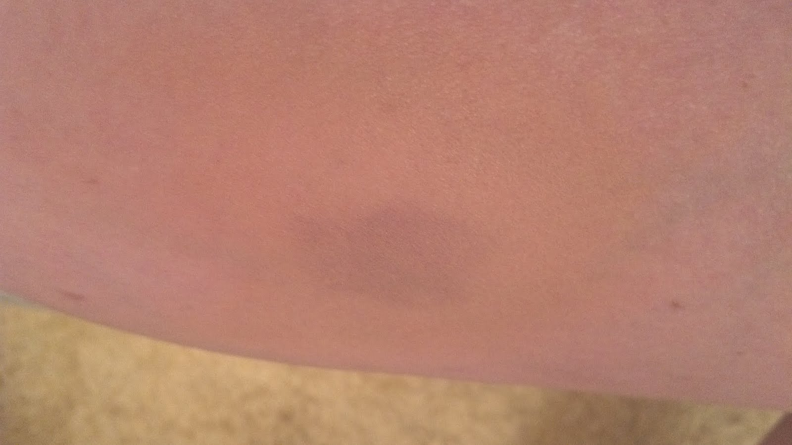 Lipstick and Leggings How To Hide A Bruise