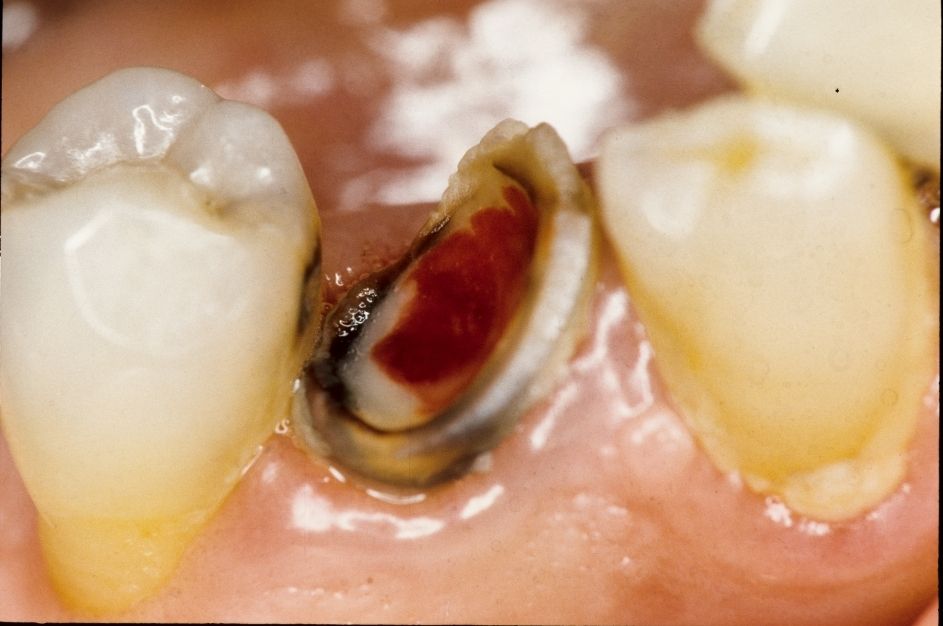 Managing Common Endodontic Emergencies OdontoTv