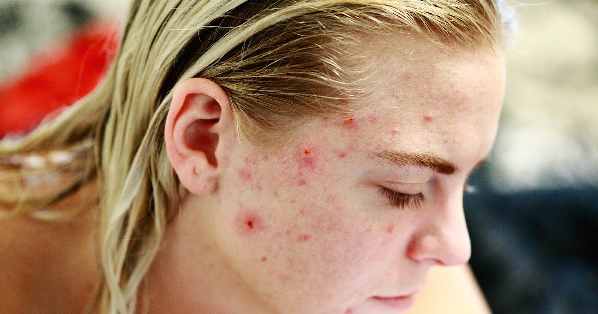 Acne is the most irritating disease among the common skin diseases because it directly affects your beauty. By the way, it is normal to have pimples a