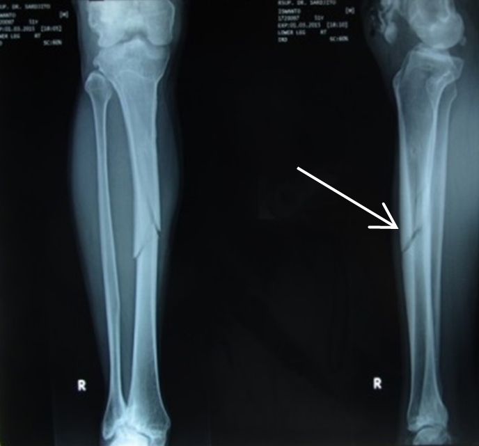 Oblique Bone Fracture Mumuchip