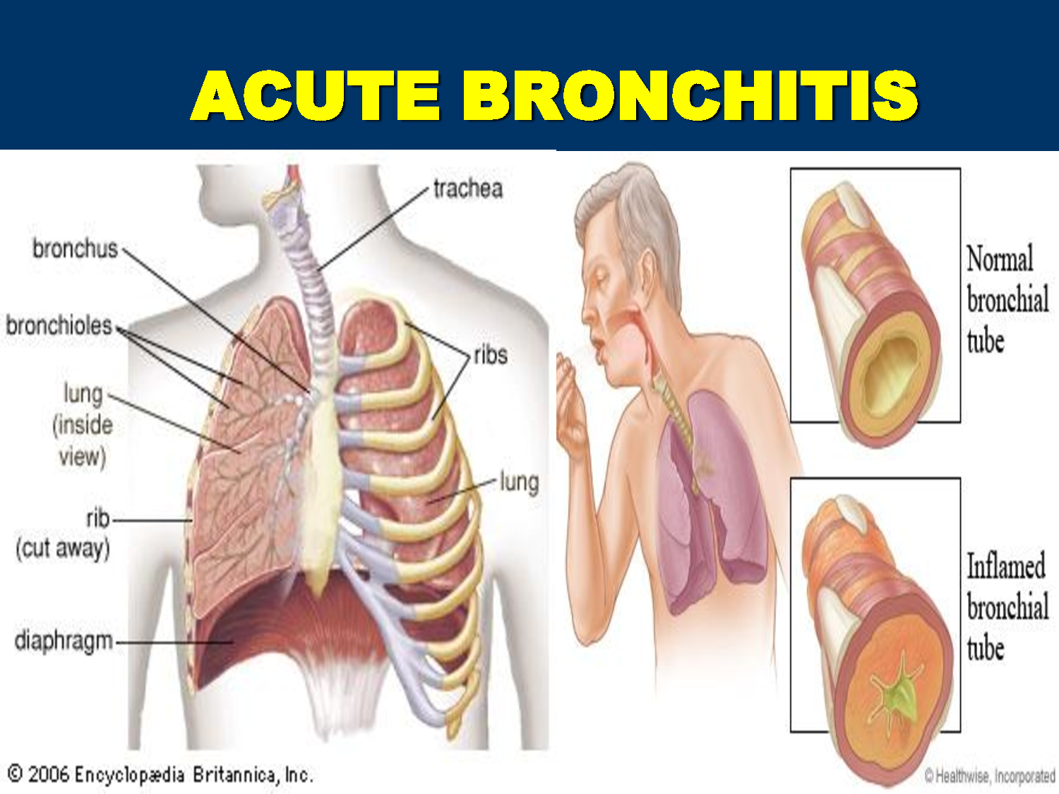 Signs of Acute Bronchitis