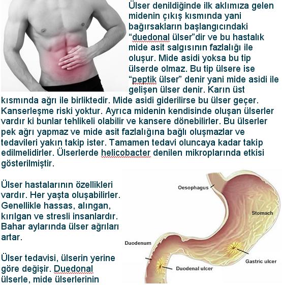search arama Ülser nedir tedavisi mide ülseri tedavisi ülser nedir