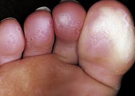 ayak mantari nedir nasil tedavi edilir