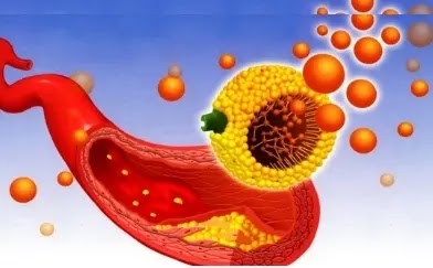 Bad Cholesterol Types LDL and VLDL Bad Cholesterol Types LDL and VLDL