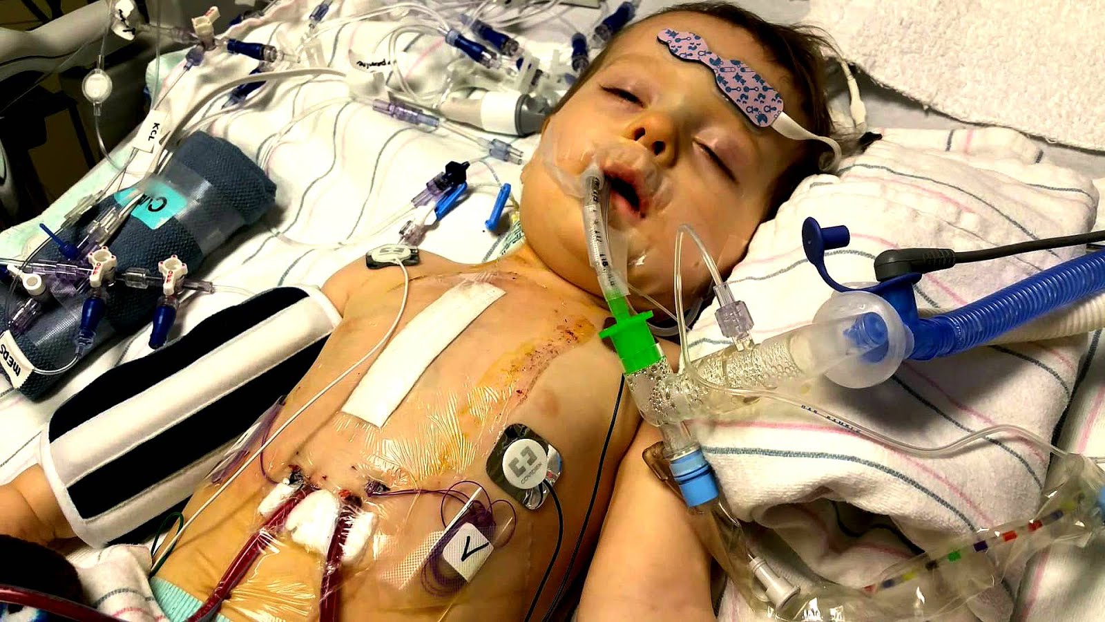 Open Heart Surgery Child Hear Choices