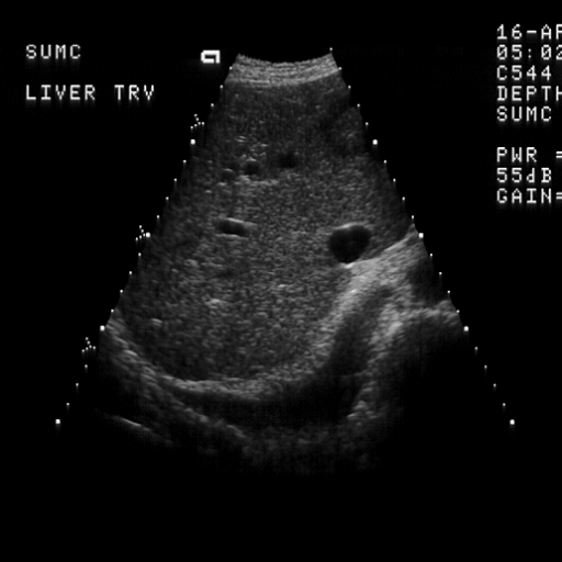 Abnormal Liver Enzymes Gallstones