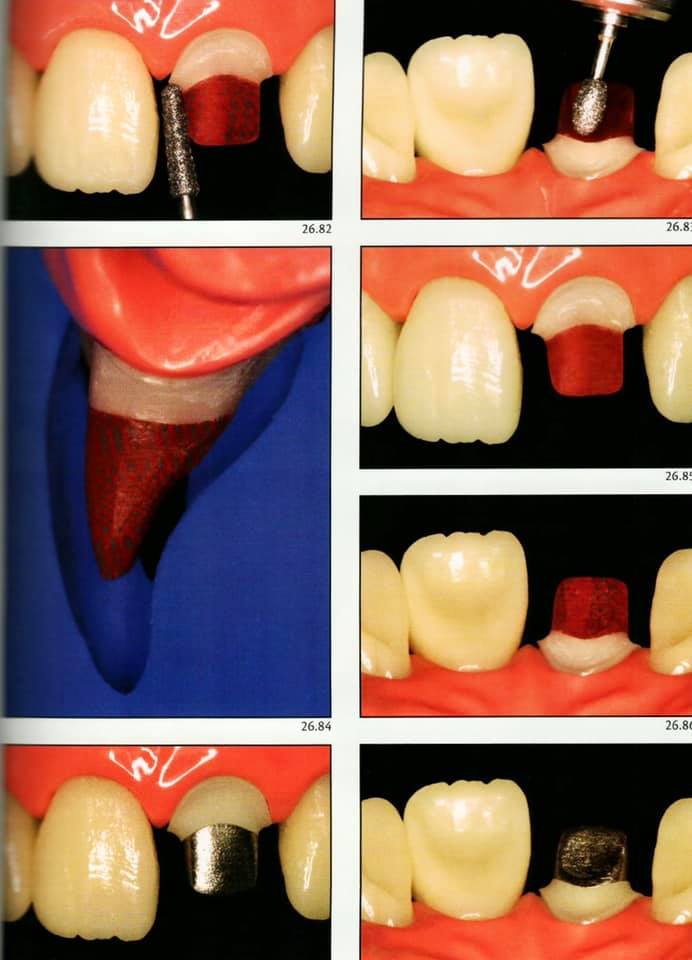 Cast metal posts Dental Esthetics