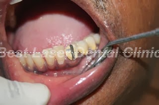 » Failed RCT crown removed and replaced with dental implant supported ...