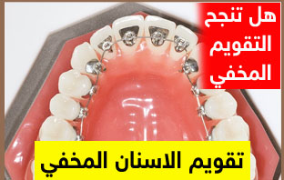 انواع تقويم الاسنان بالصور