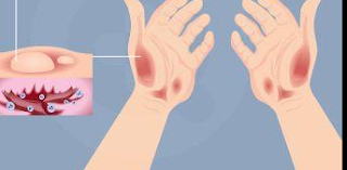 Manfaat Obat Gentamicin yang Ada di SehatQ dan Pemakaiannya Manfaat Obat Gentamicin yang Ada di SehatQ dan Pemakaiannya