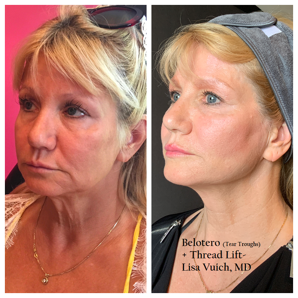 What Is A PDO Thread Lift?