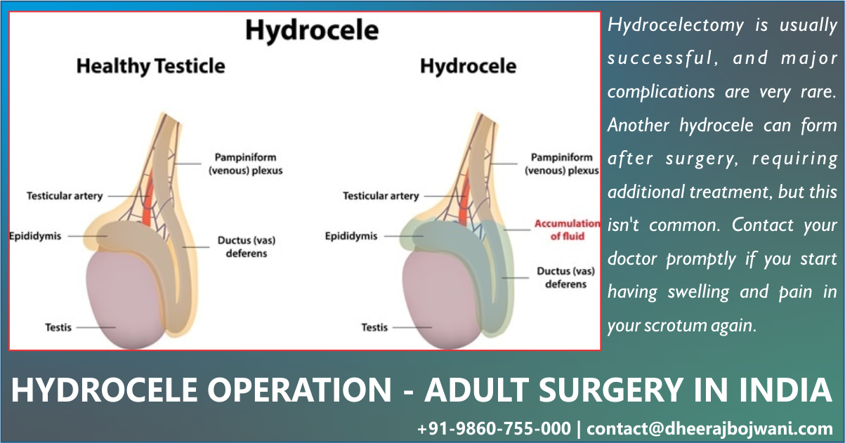 Overview: Hydrocele Surgery 