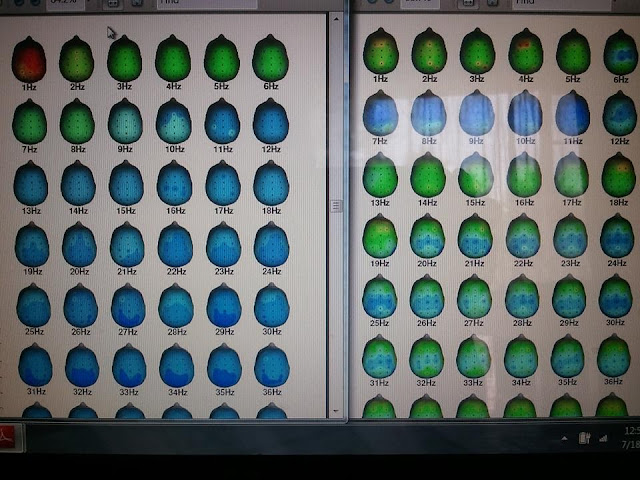 Ken's QEEG comparison.