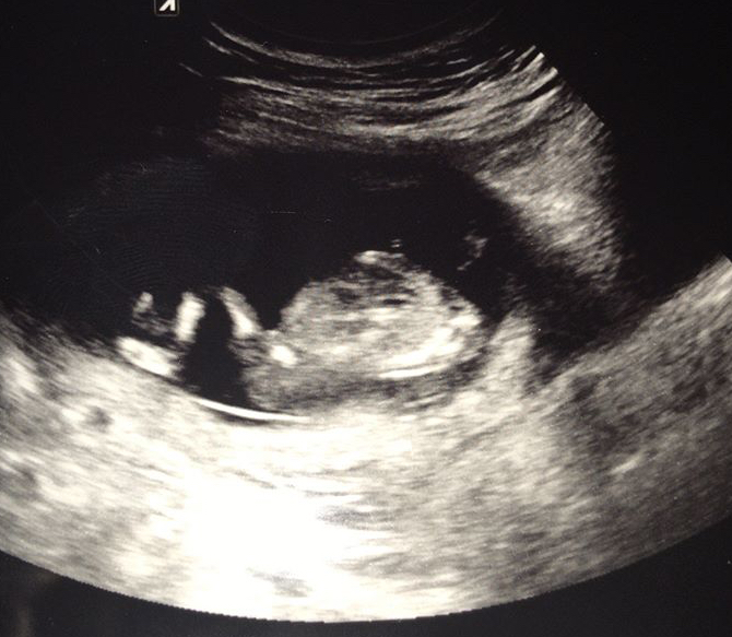 15 Haftalık Gebelik Ultrason Görüntüleri