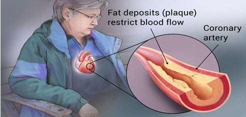 CORONARY HEART DISEASE