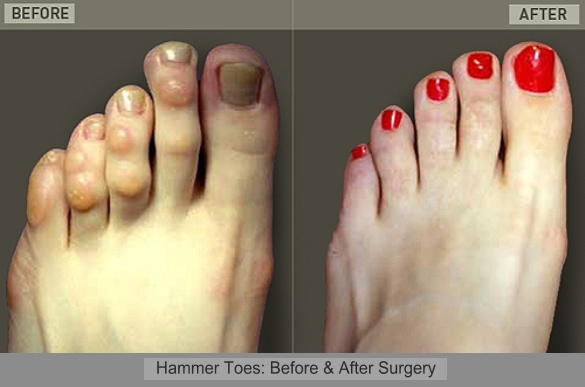 About Hammer Toe - Health And Medical Information