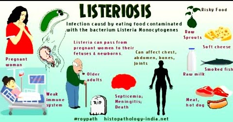 listeriosis symptoms food and prevention