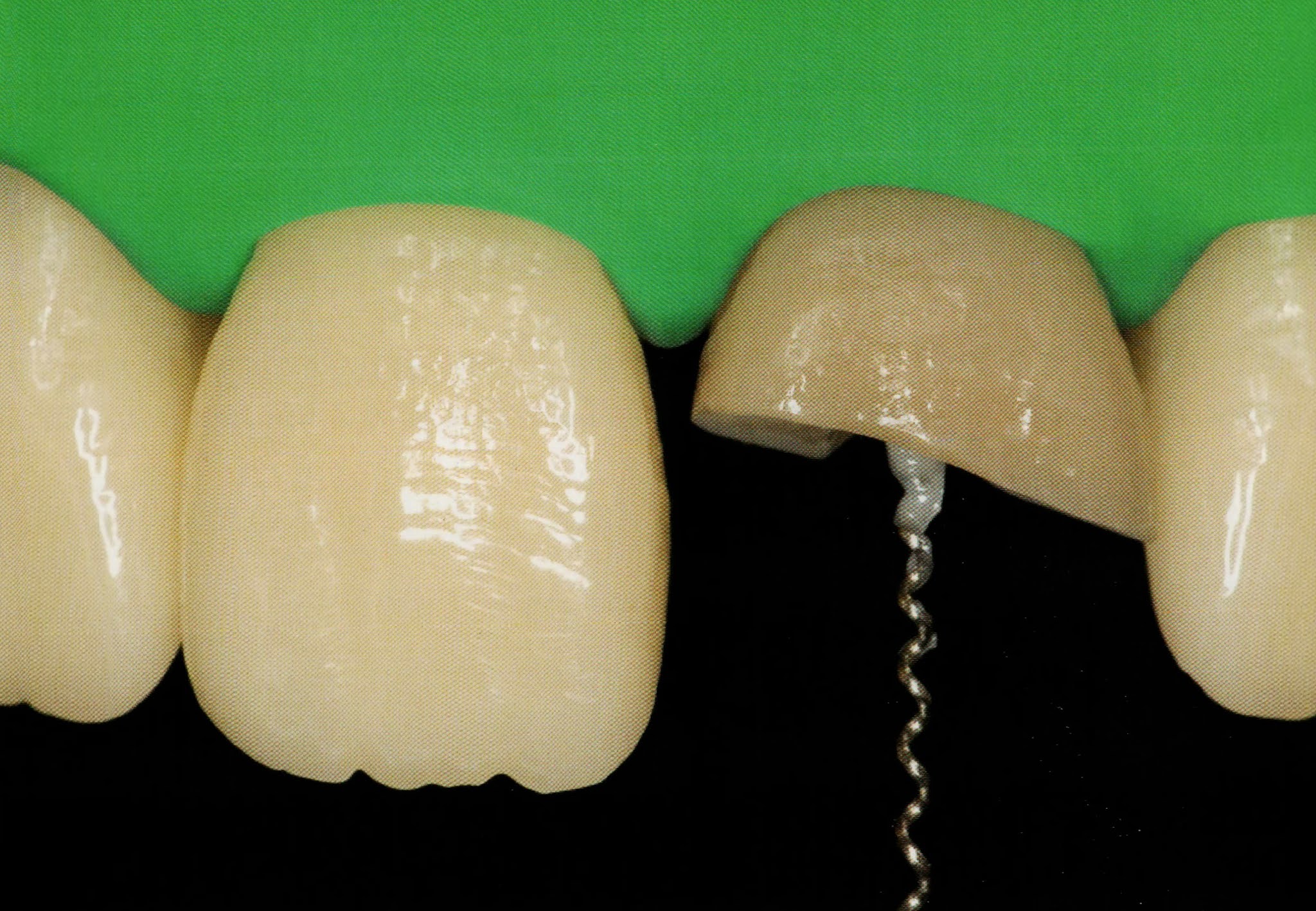 How to cement a fiber post ? Dental Esthetics