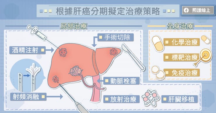 根據肝癌分期擬定治療策略