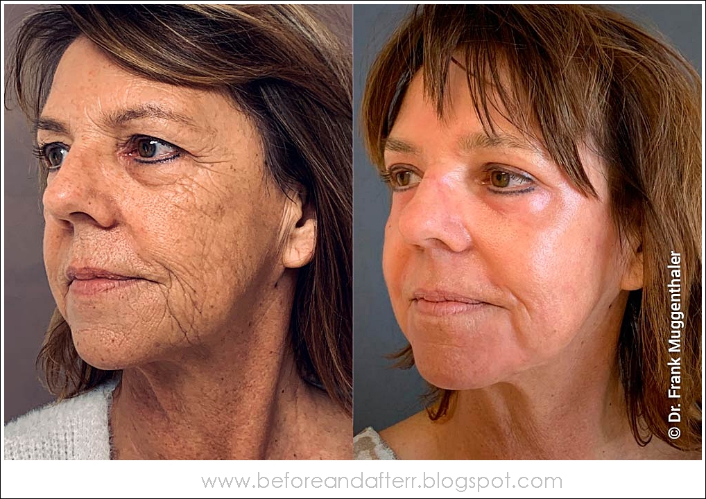 Phenol peelingBEFORE AFTER PICTURES Real Before and After