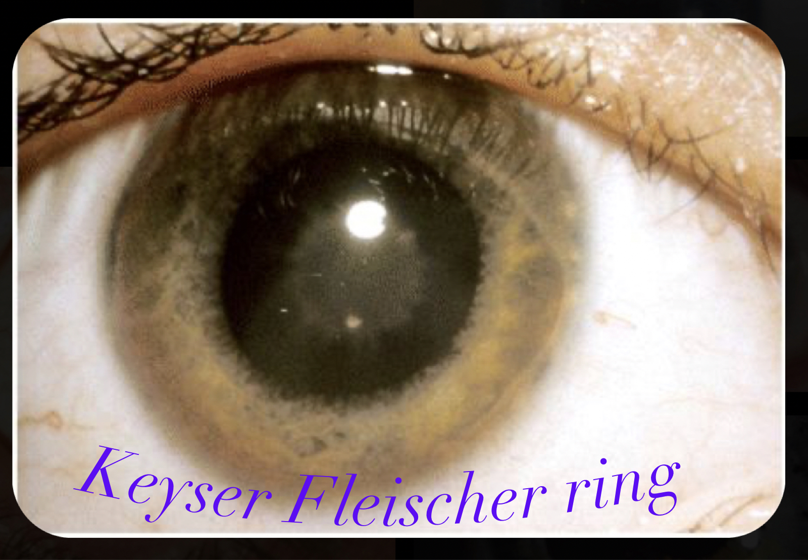 "THE COPPER HEAD" AN INTRODUCTION TO WILSON'S DISEASE !!! BY DR