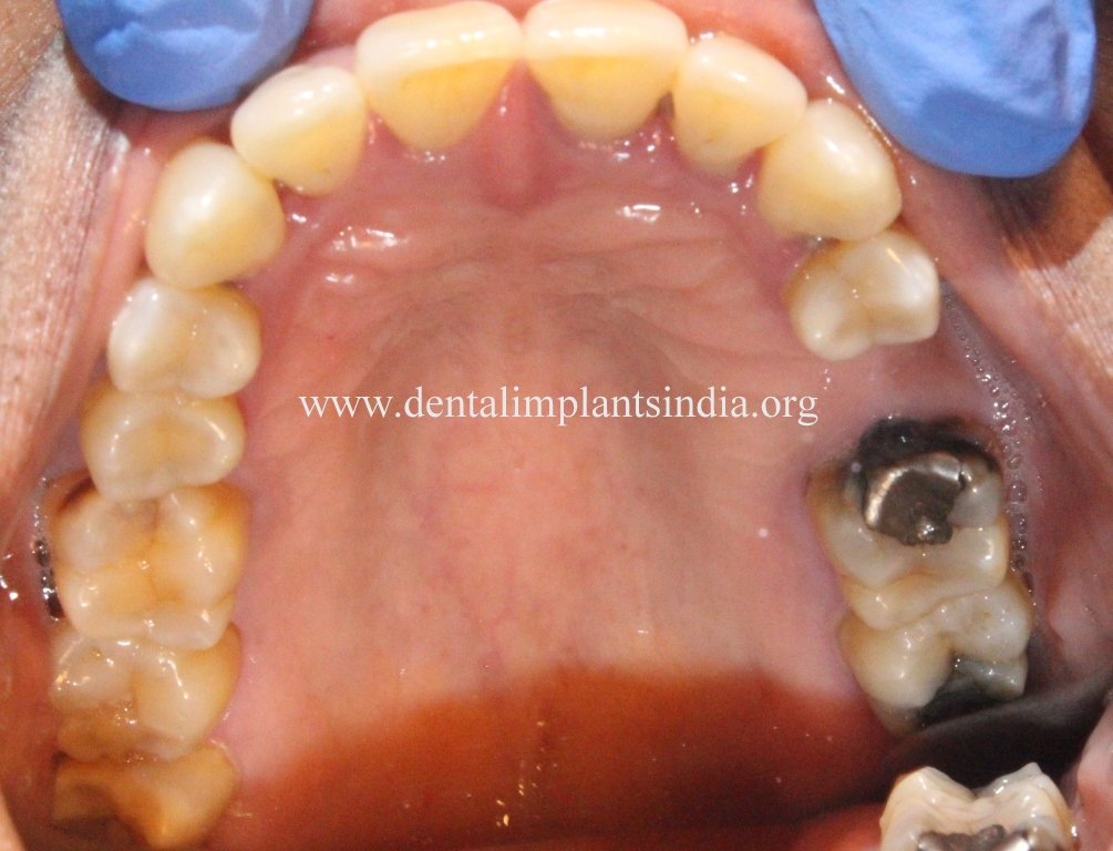 Chinthamani Laser Dental Clinic DENTAL TOURISM IN CHENNAI INDIA FOR