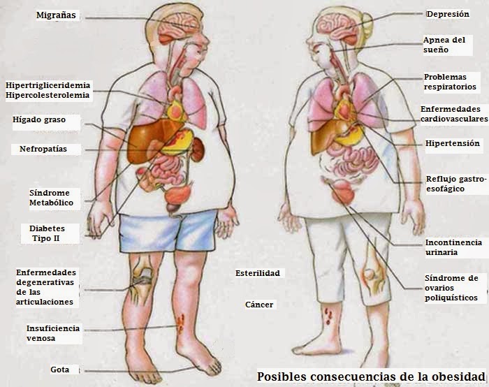 riesgos de la obesidad