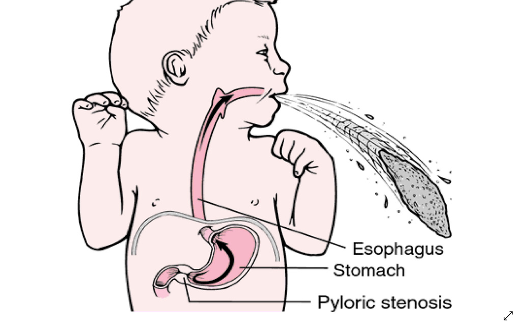 Пищевод у детей. Пилороспазм и пилоростеноз у детей. Пилоростеноз и пилороспазм рентген. Пилоростеноз рвота фонтаном. Пилоростеноз у новорожденных.