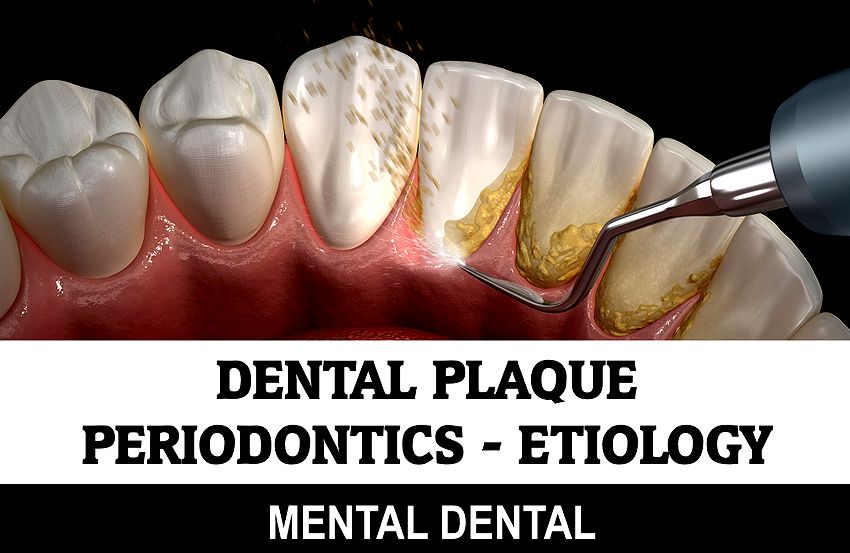 DENTAL PLAQUE Composition and Etiology Mental Dental