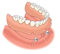Todo lo que debes saber sobre los implantes dentales 18