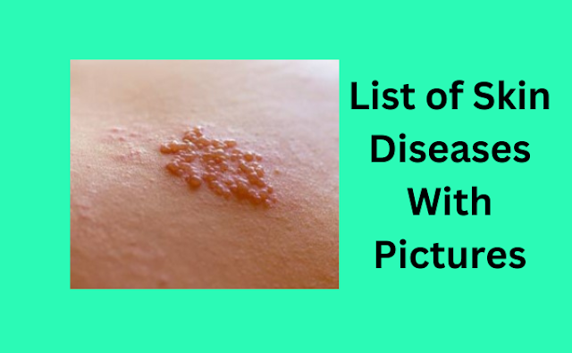 List of Skin Diseases with Pictures