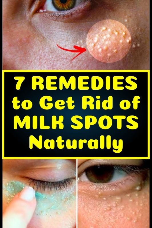 These 7 Remedies Can Remove The Milia (Milk Spots) From Your Face Healthy Lifestyle